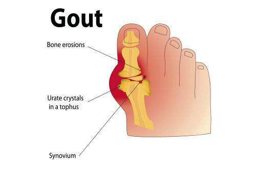 Gout - a painful form of arthritis - Jamaica Observer